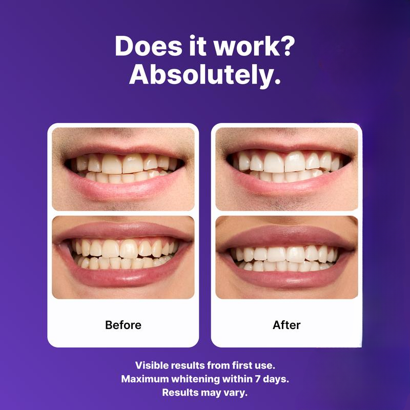 Purple Teeth Whitening Strips - 7/21 Whitening Sessions - Safe - Non Sensitive Teeth Whitening - Peroxide-Free